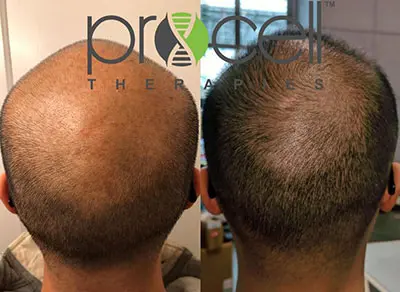 A man with and without hair loss is shown.